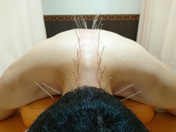 鍼灸整骨院イワサキ 鍼